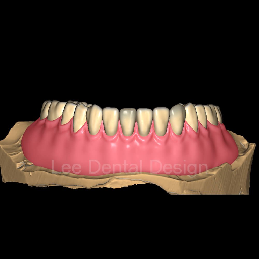 Digital denture design case in CAD showing the tooth setup built against the ridge and the neutral zone