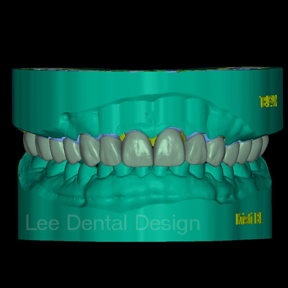 All-on-X bridge design case file for a full arch implant bridge, ready to mill or print