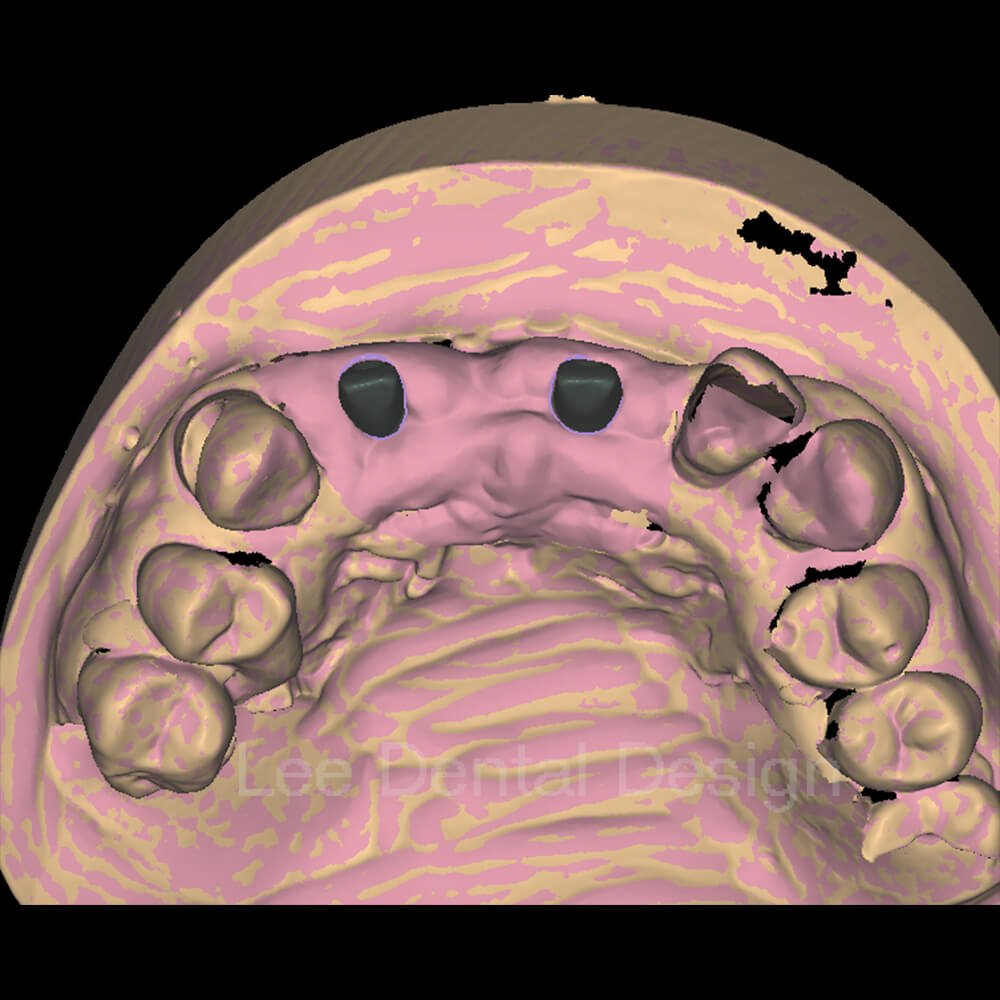 Custom abutment design in CAD with the screw channel and connection matched to the implant library
