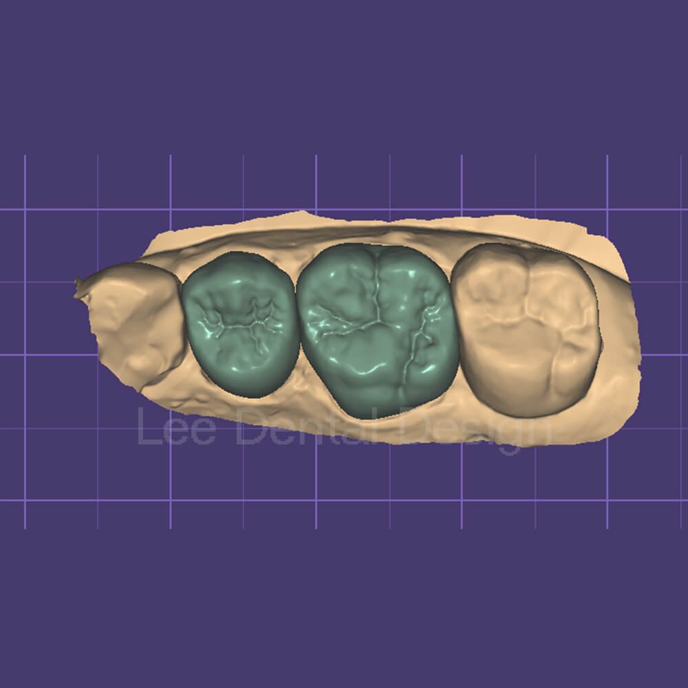 Crown and bridge design case in exocad with margins traced and contacts verified