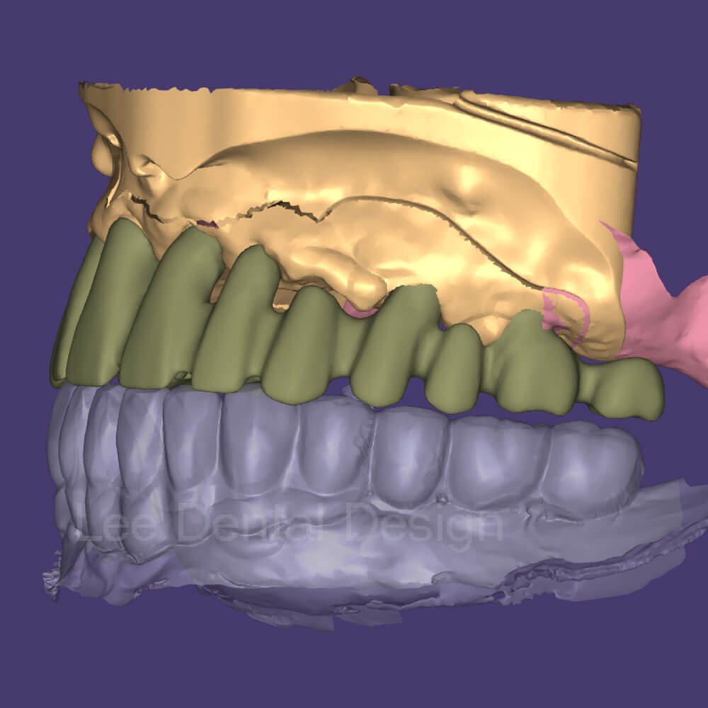 Coping designed in CAD with the internal spacer and occlusal clearance checked before release