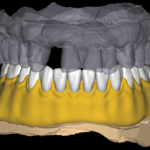 Acrylic Denture Design 1-1