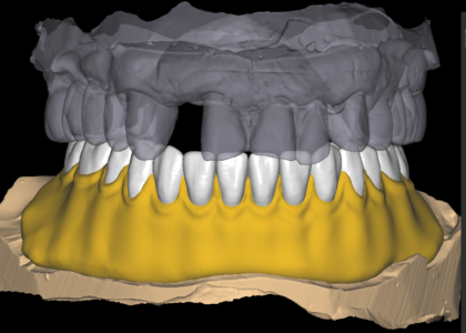 Acrylic Denture Design 1-1