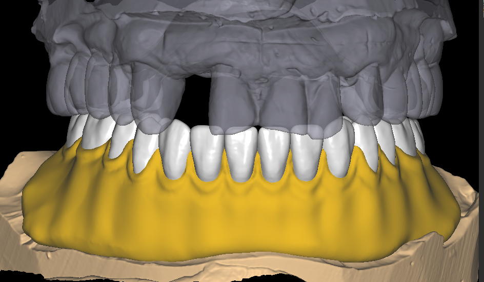 Acrylic Denture Design 1-1