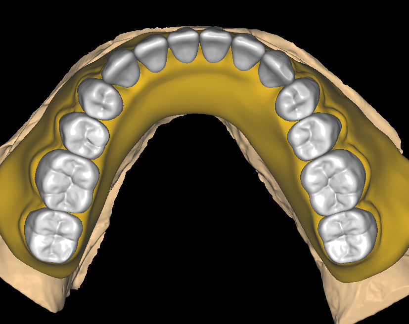 Digital denture design setup with the tooth mould and shade selected before the base is built