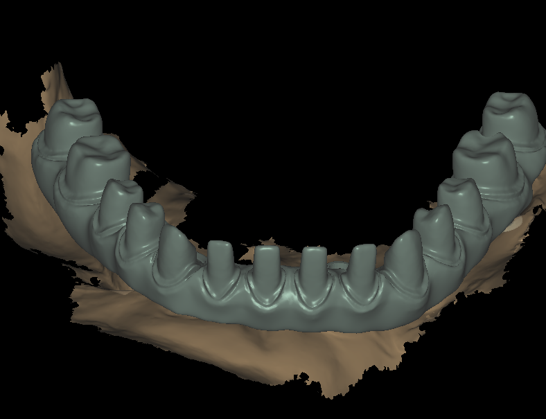 All-on-X Bridge Design 4-1