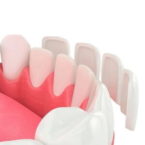 Ceramic Veneers Design