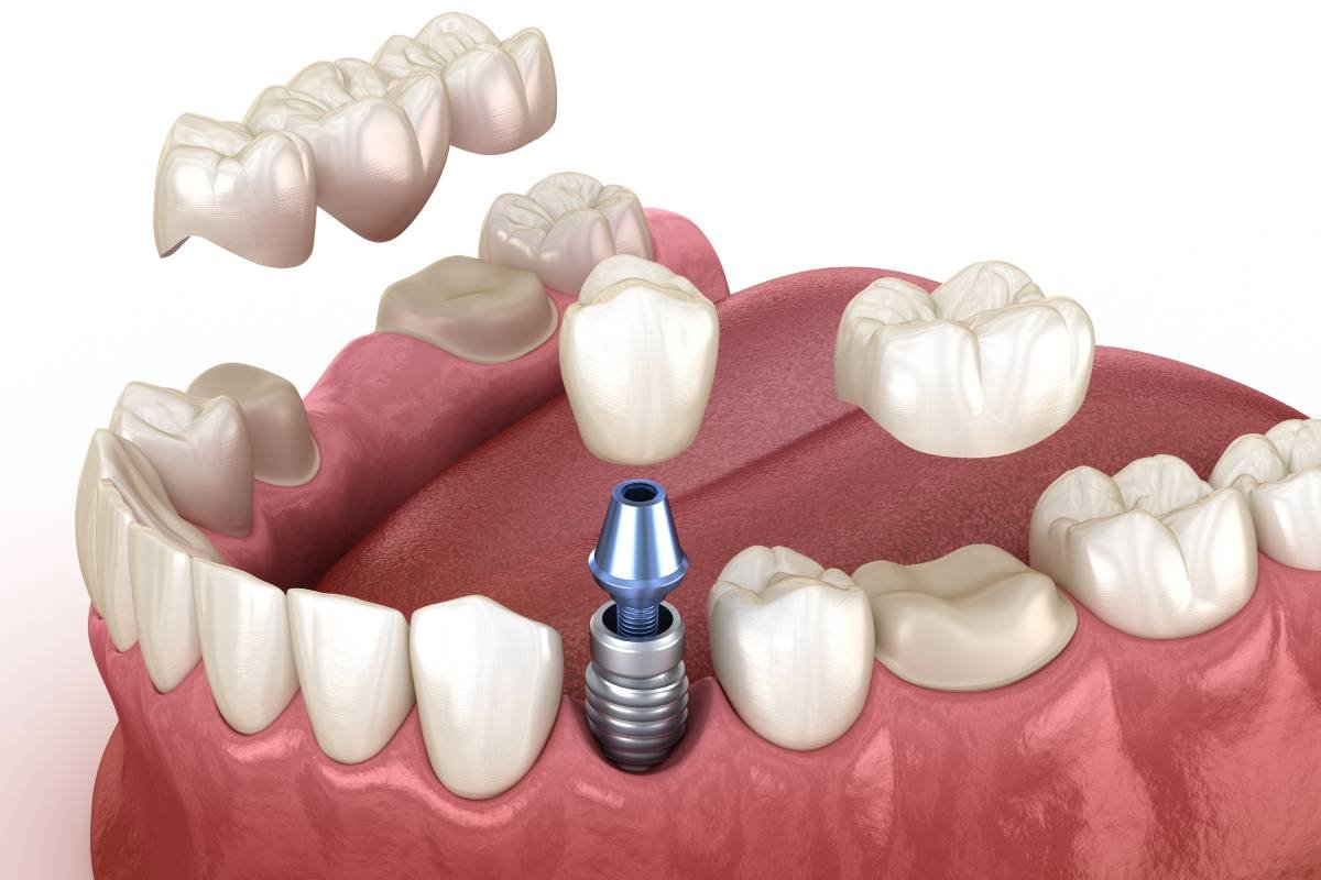 Cement gap design on a crown and bridge case with the margin zone and internal spacer set as separate values
