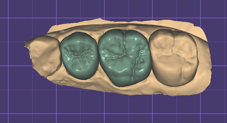 Three-unit bridge design on a scanned model, ready for the CAM queue