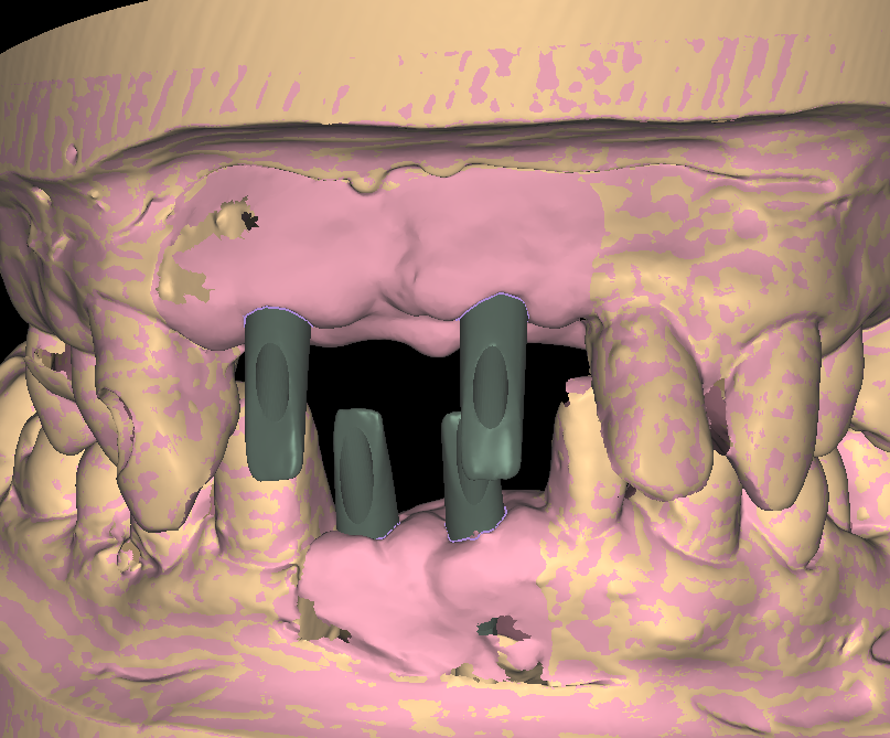 Anterior implant sites scanned with soft-tissue contours before contour work begins