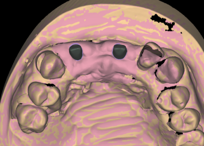Emergence profile design on two custom abutments emerging through scanned soft tissue