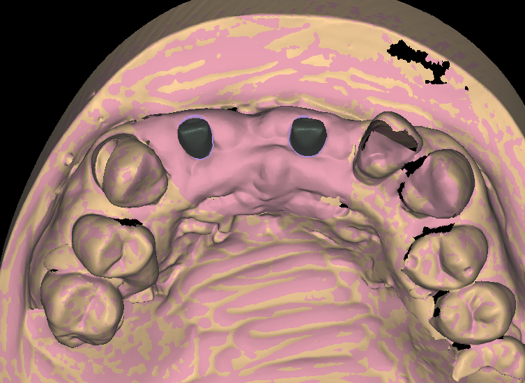 Emergence profile design on two custom abutments emerging through scanned soft tissue