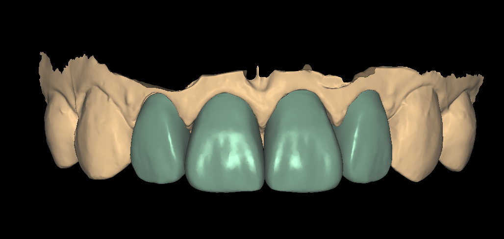 3D mock-up file built from the approved digital smile design plan