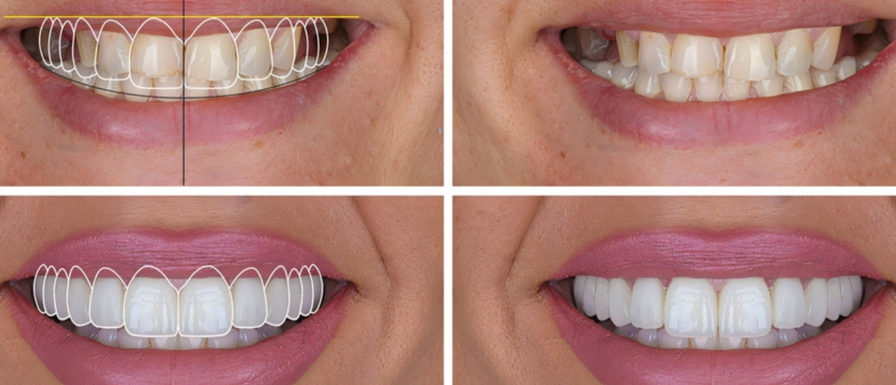 Digital smile design case: 2D simulation overlay, the starting smile and the final result