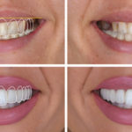 Digital smile design case: 2D simulation overlay, the starting smile and the final result