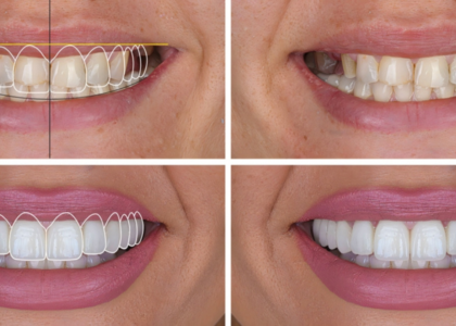Digital smile design case: 2D simulation overlay, the starting smile and the final result