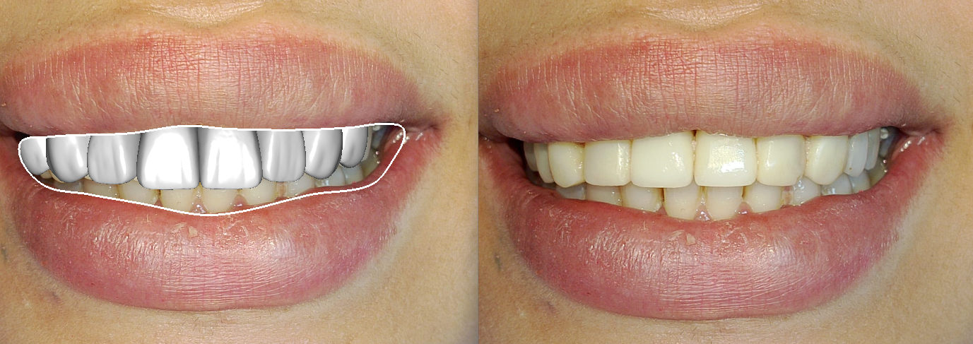 DSD Smile Design 6-1