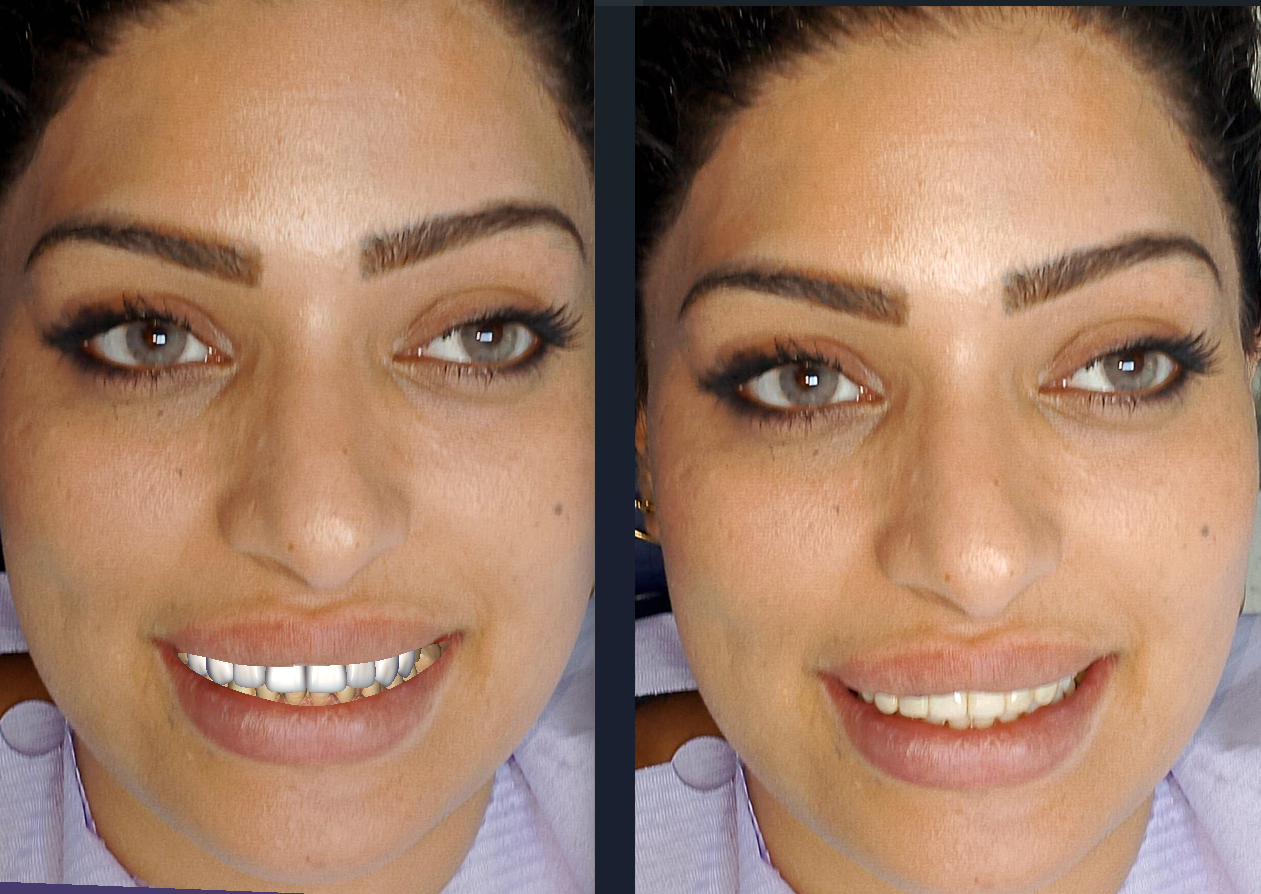 Facial reference lines and tooth proportions checked on the patient's own photo