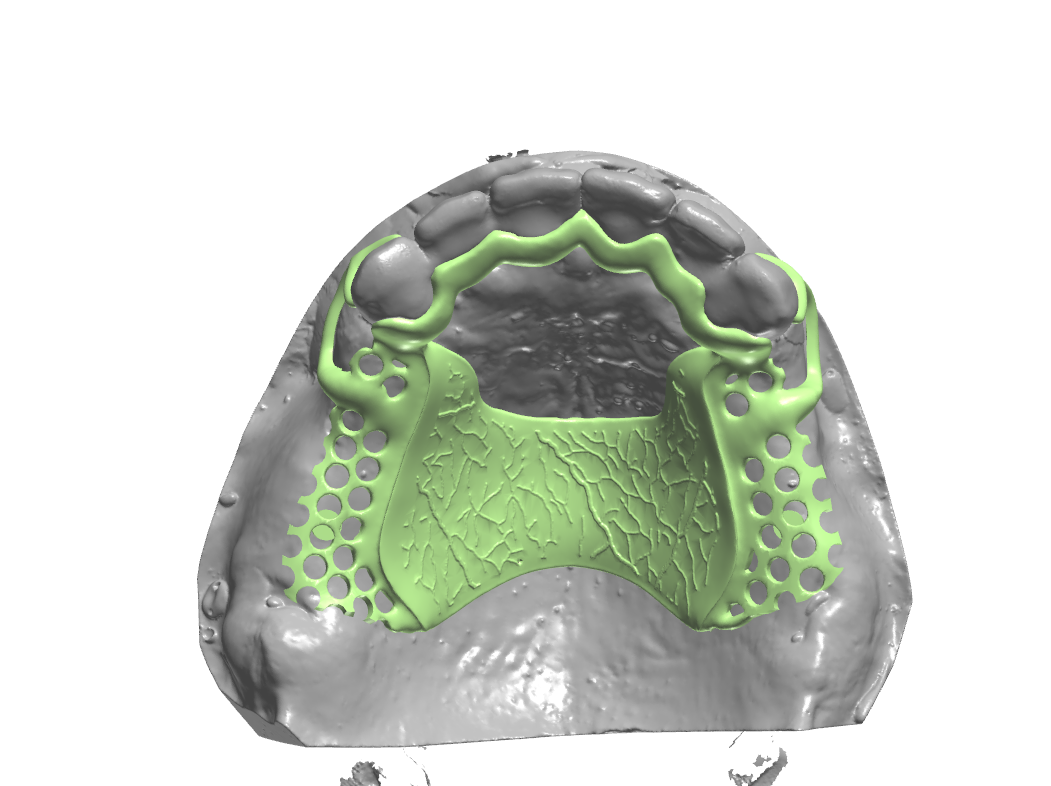 Metal framework design in CAD on a maxillary scan, with the palatal strap and retention grid set to the survey line