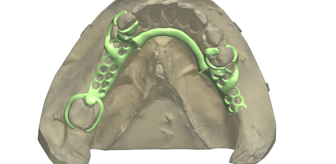 Metal framework design on a scanned mandibular cast: the lingual bar framework after digital survey and block-out