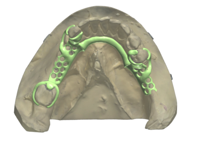 Metal framework design on a scanned mandibular cast: the lingual bar framework after digital survey and block-out