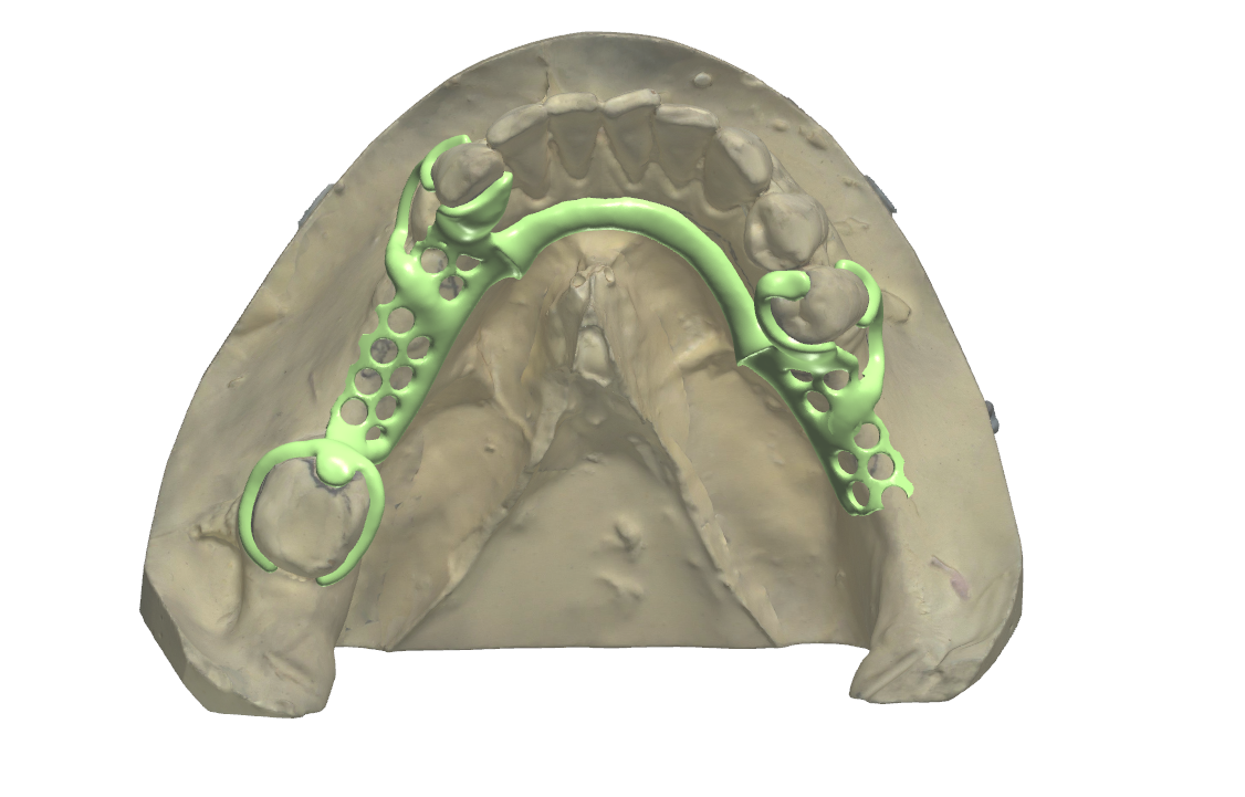 Metal framework design on a scanned mandibular cast: the lingual bar framework after digital survey and block-out