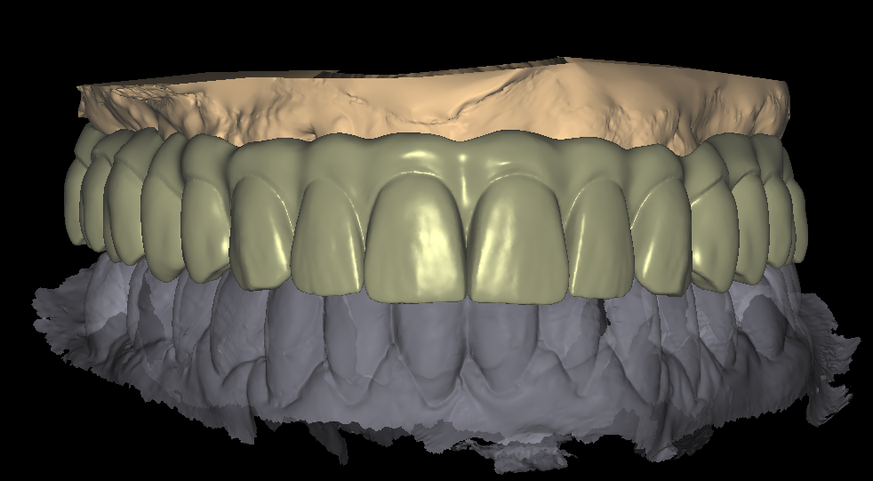 Implant Bar Design 1-2