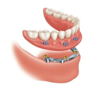 Implant Bar Design -1