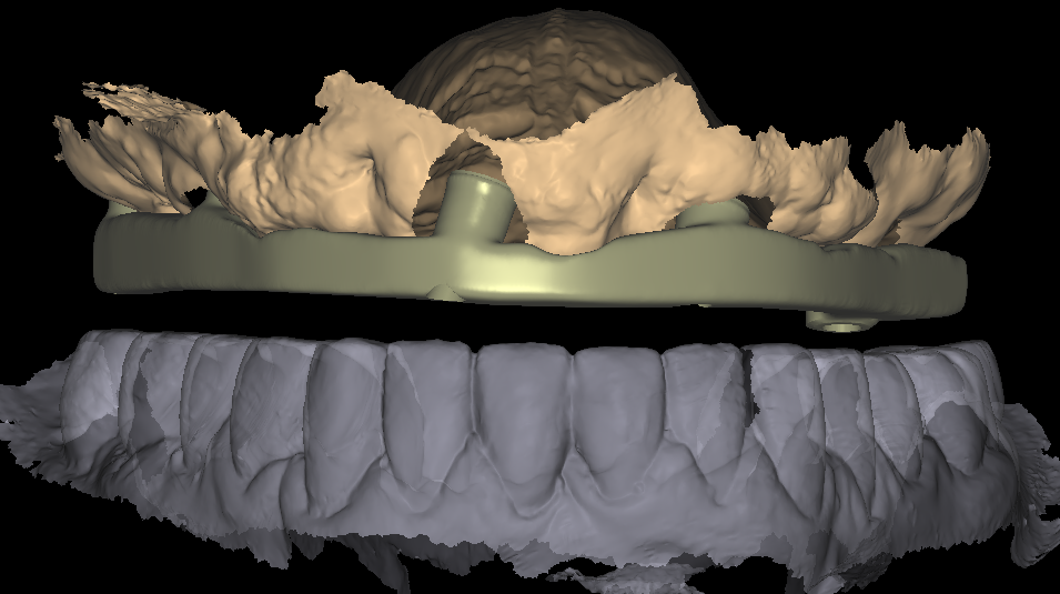 Implant bar design over multi-unit abutments on a verified implant-level scan