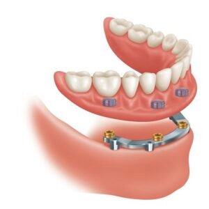 Implant Bar Design -1