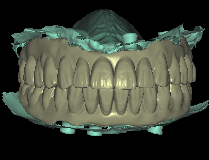 Implant Bar Design 2-1