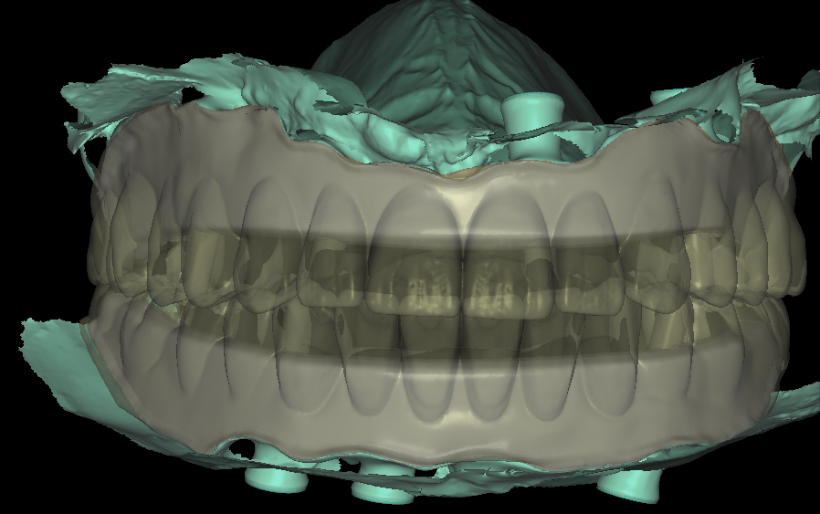 Full-arch overdenture tooth setup designed around an implant bar
