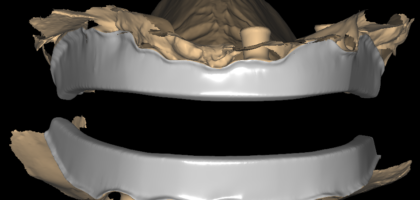 Implant bar design case: two horseshoe bar frameworks seated over scanned arches