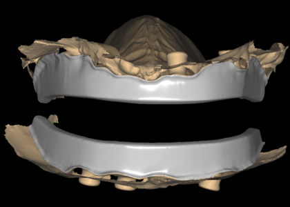Implant bar design case: two horseshoe bar frameworks seated over scanned arches