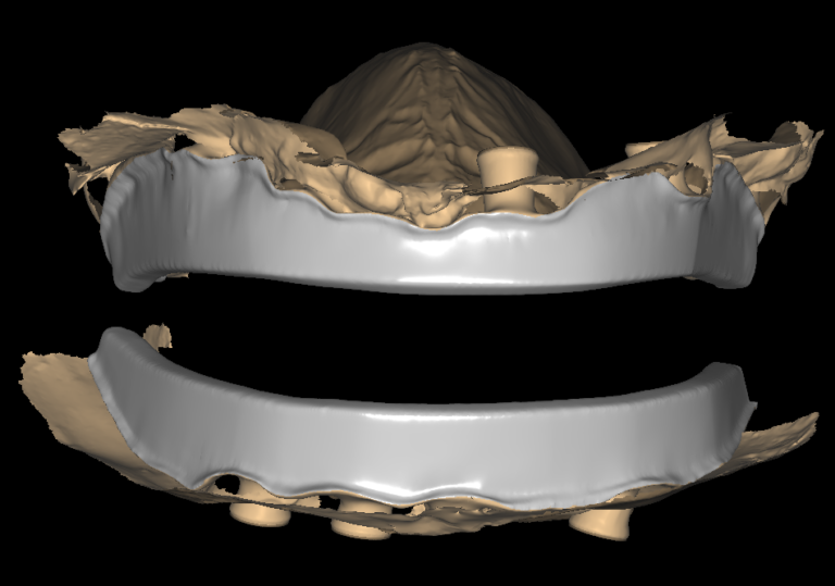 Implant Bar Design: Hader, Dolder and Milled Bars Compared