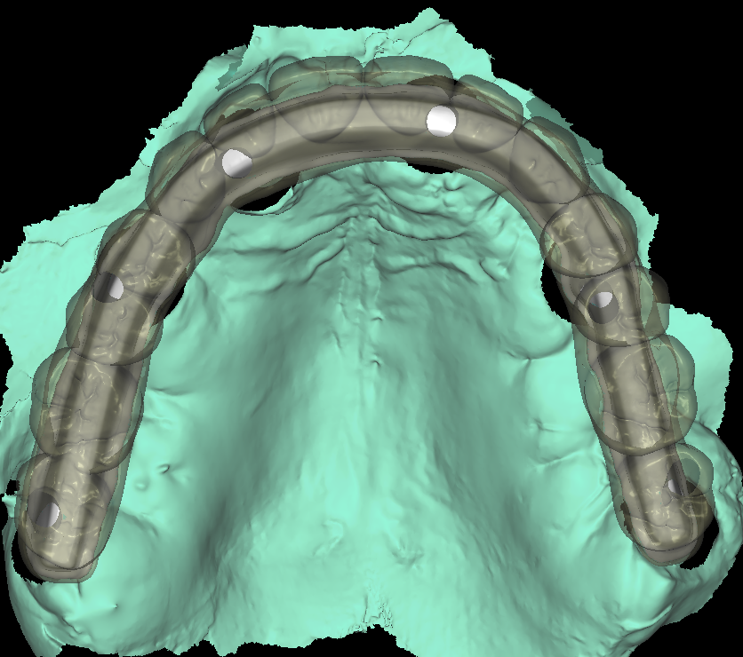 Implant Bar Design 2-4