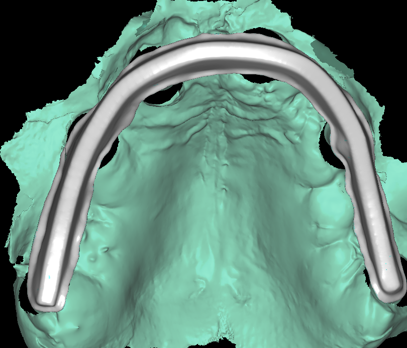 Implant Bar Design 2-5