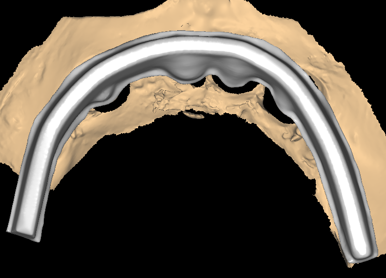 Implant Bar Design 2-6