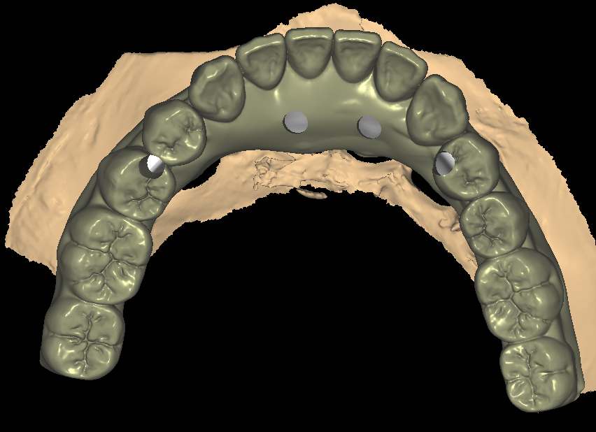 Implant Bar Design 2-7