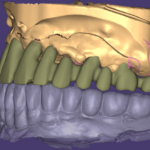PFM coping design case: copings on the upper scan beside the opposing arch