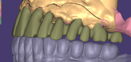 PFM coping design case: copings on the upper scan beside the opposing arch
