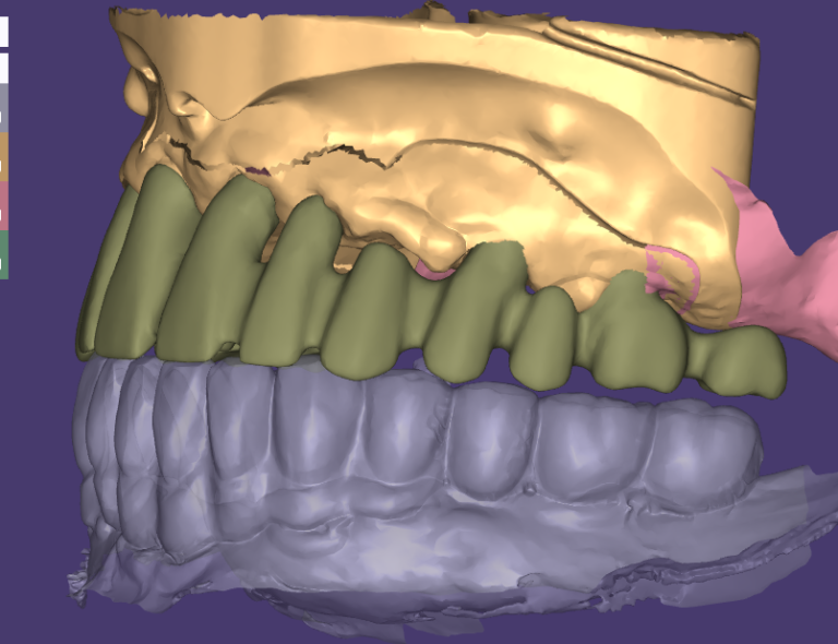 PFM Coping Design: Thickness, Cutback and Fit