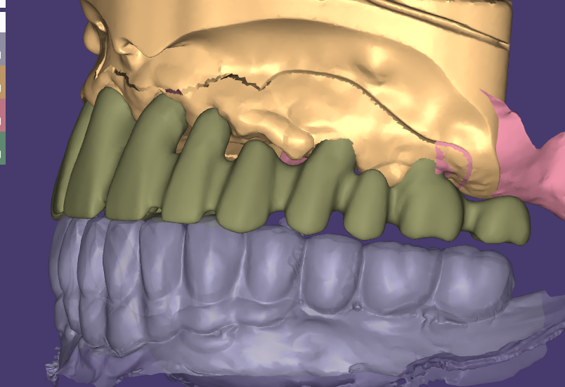 PFM coping design case: copings on the upper scan beside the opposing arch