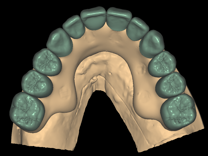 Occlusal view of a full-arch screw-retained design during a quality check
