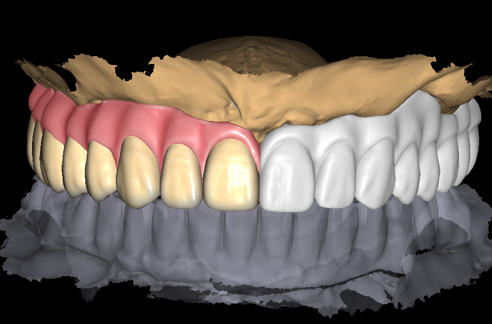 Screw-retained bridge design finished in exocad and ready for review