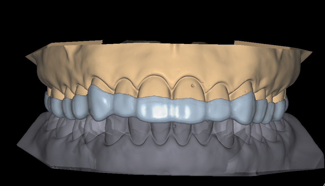 Splint Design1-1