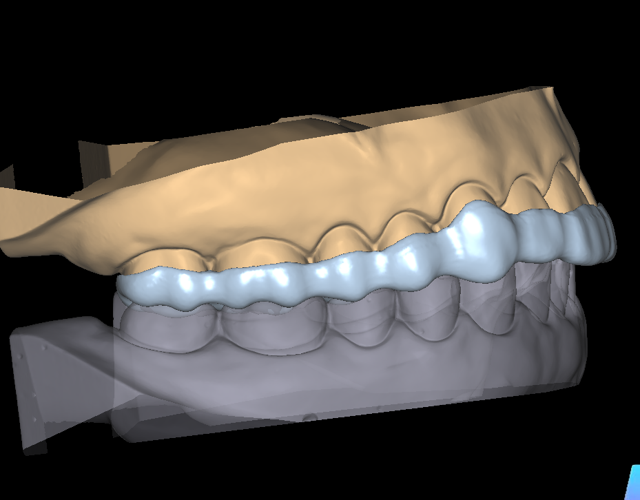 Splint Design1-2