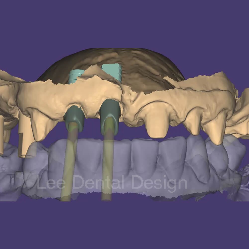 Titanium and zirconia abutment design reviewed before the file is released