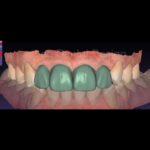 Dental CAD design case from our archive