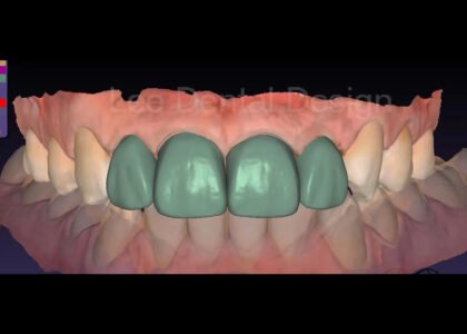 Dental CAD design case from our archive